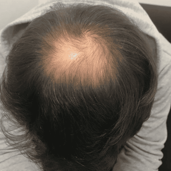 KSL hair transplant