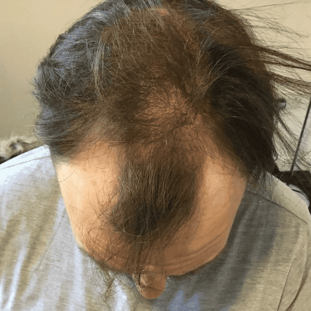 KSL hair transplant