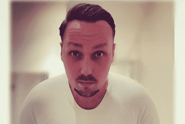 KSL hair transplant
