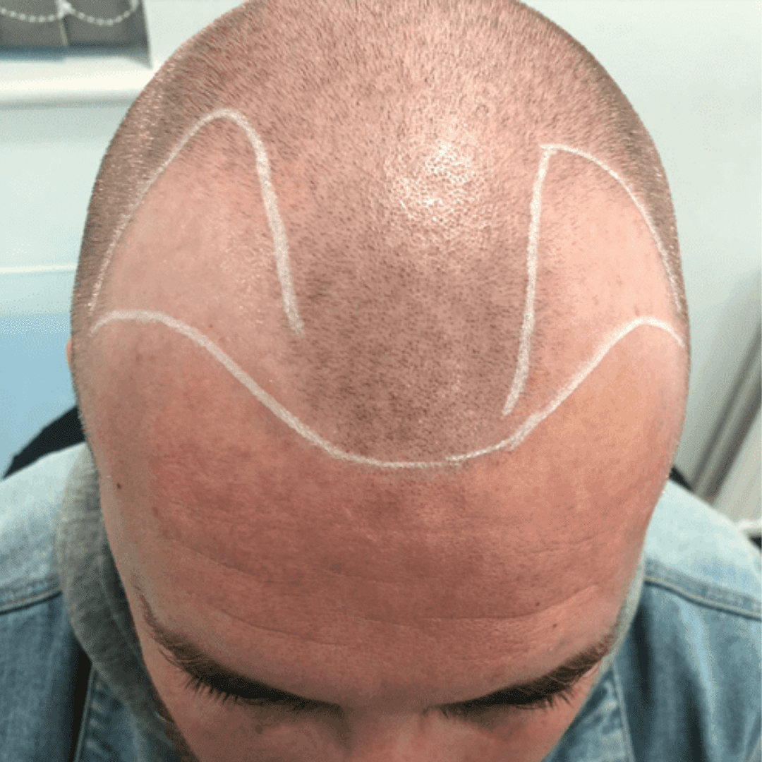 KSL hair transplant