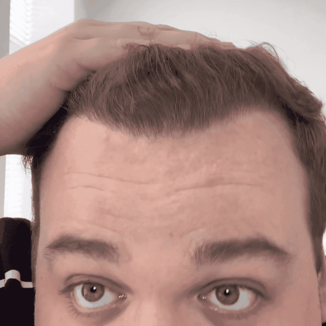 KSL hair transplant