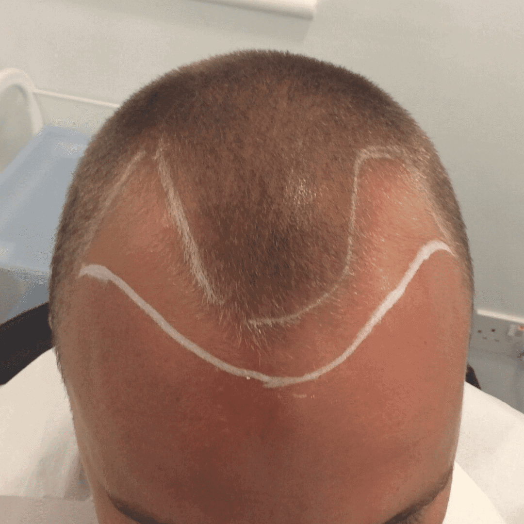 KSL hair transplant