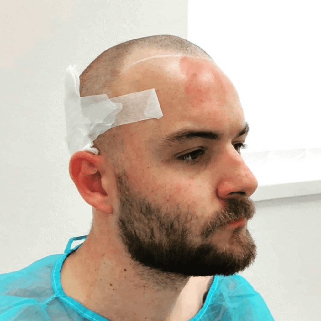 KSL hair transplant