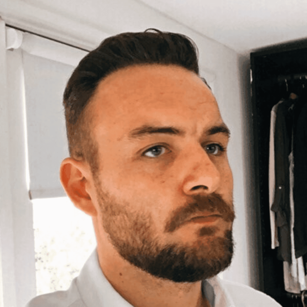 KSL hair transplant