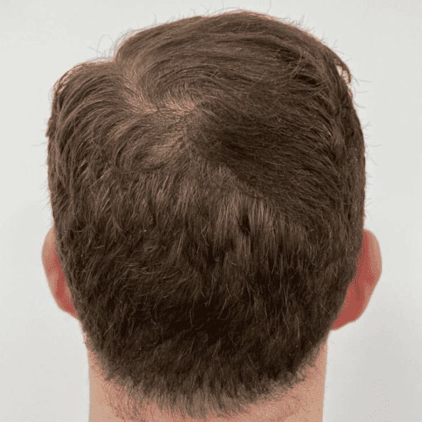 KSL hair transplant