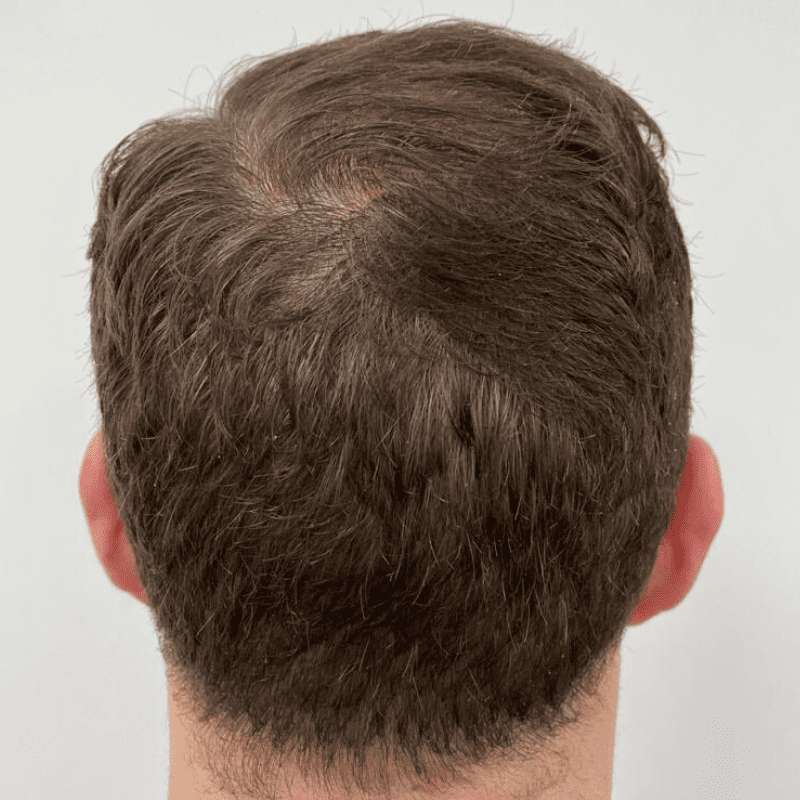 KSL hair transplant