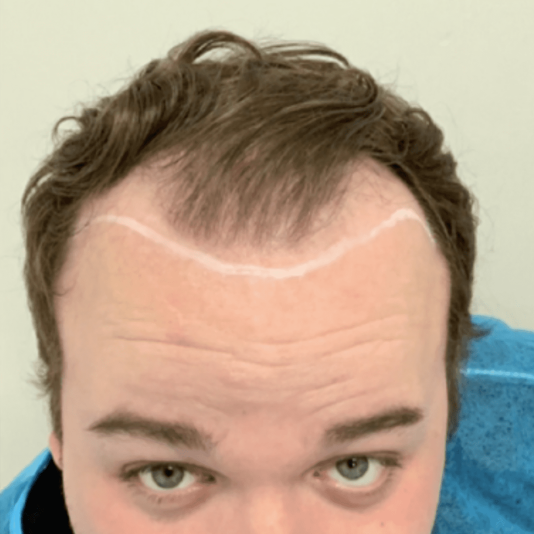 KSL hair transplant