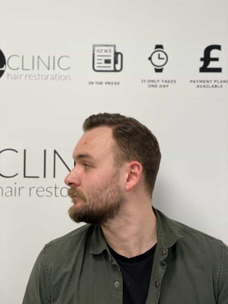 KSL hair transplant