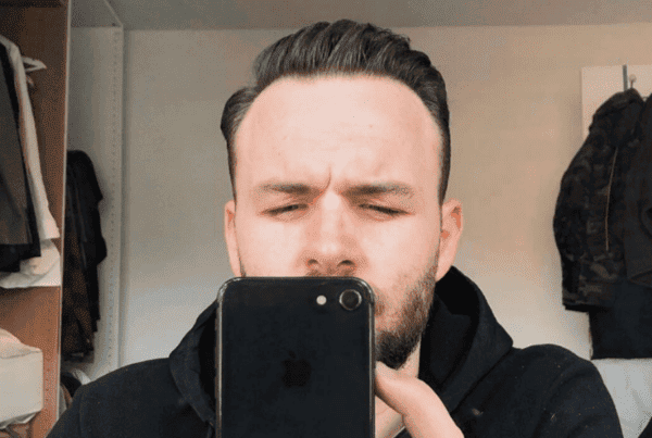 KSL hair transplant