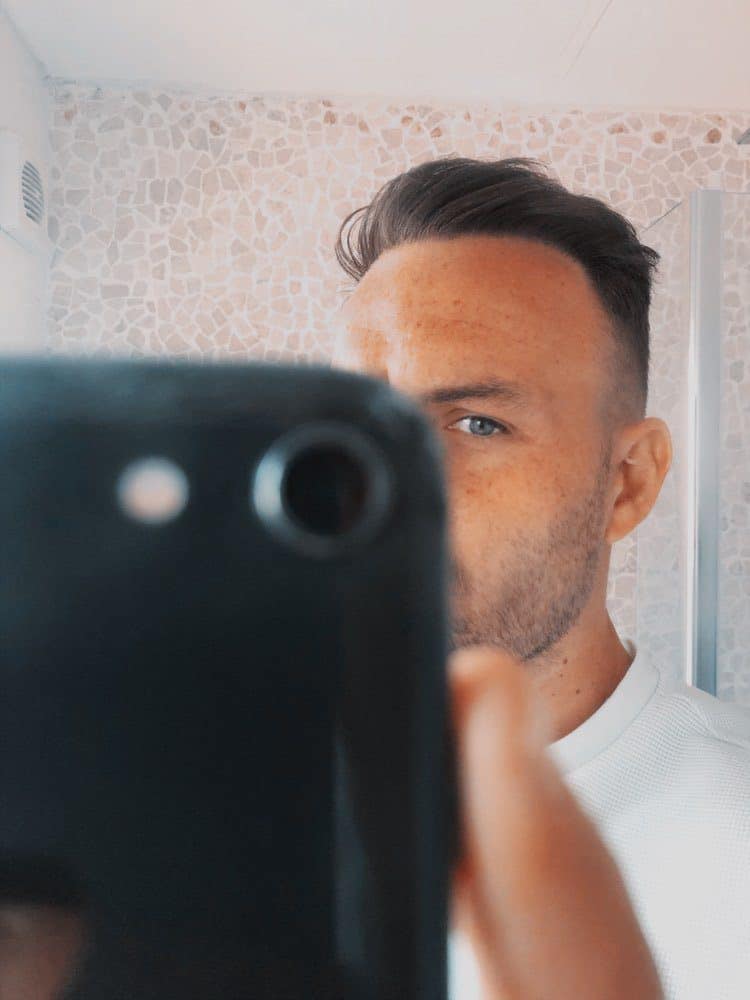 KSL hair transplant