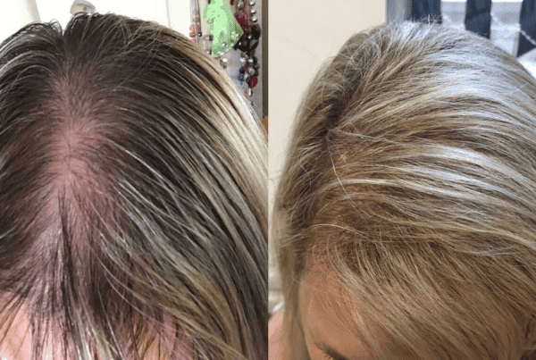 KSL hair transplant