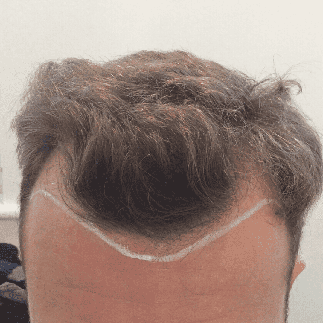 KSL hair transplant