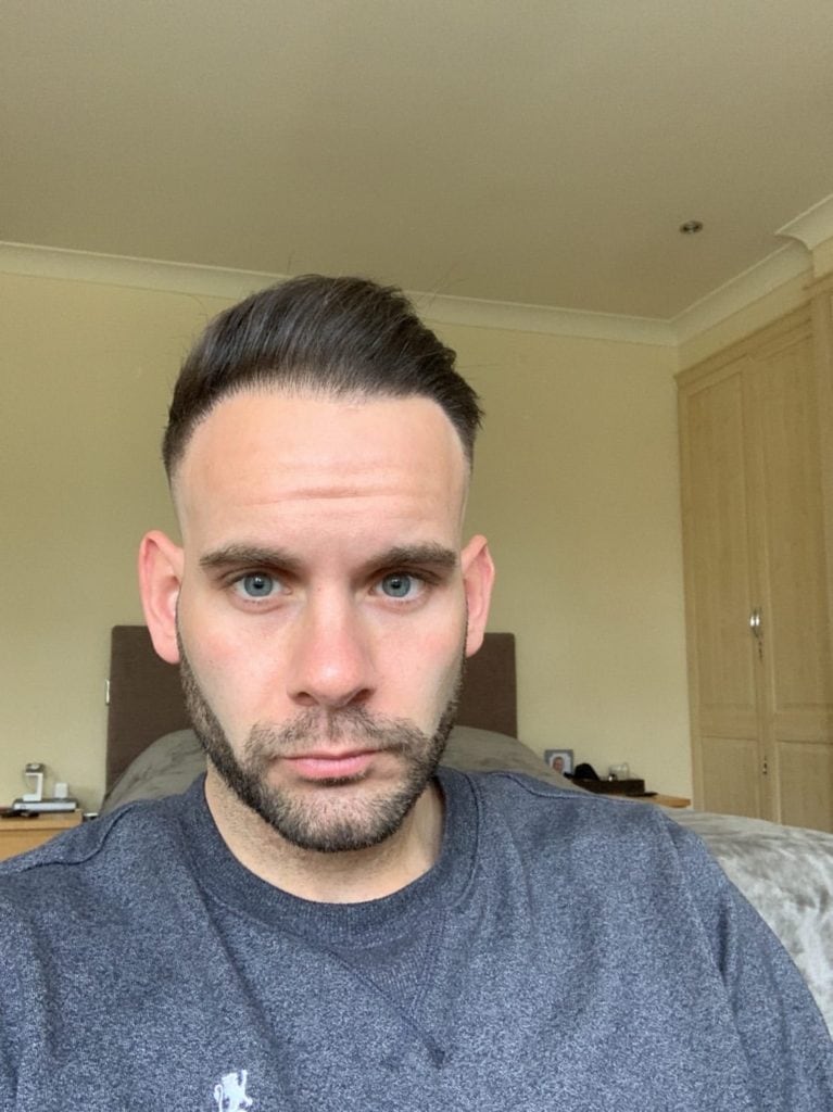 KSL hair transplantKSL hair transplant