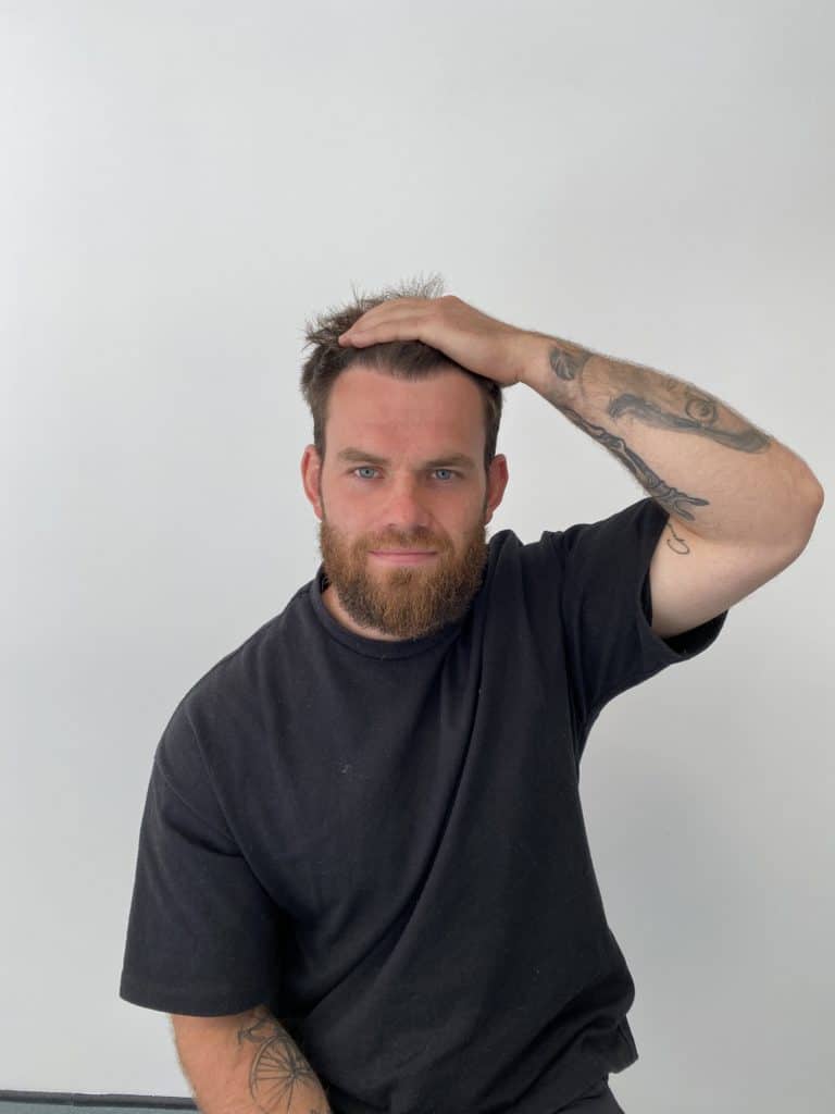 KSL hair transplant