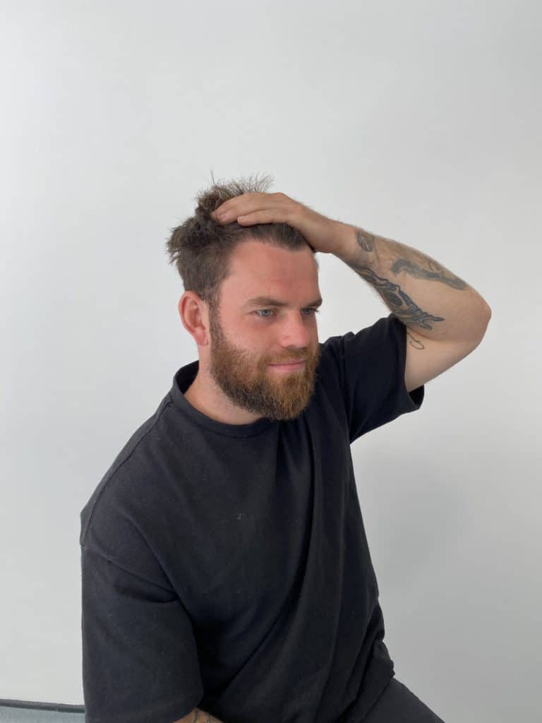 KSL hair transplant