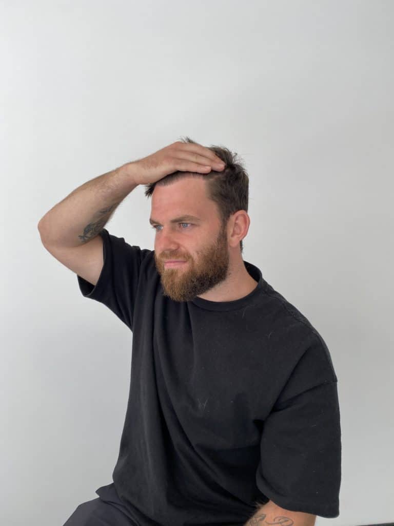 KSL hair transplant