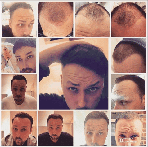 KSL hair transplant