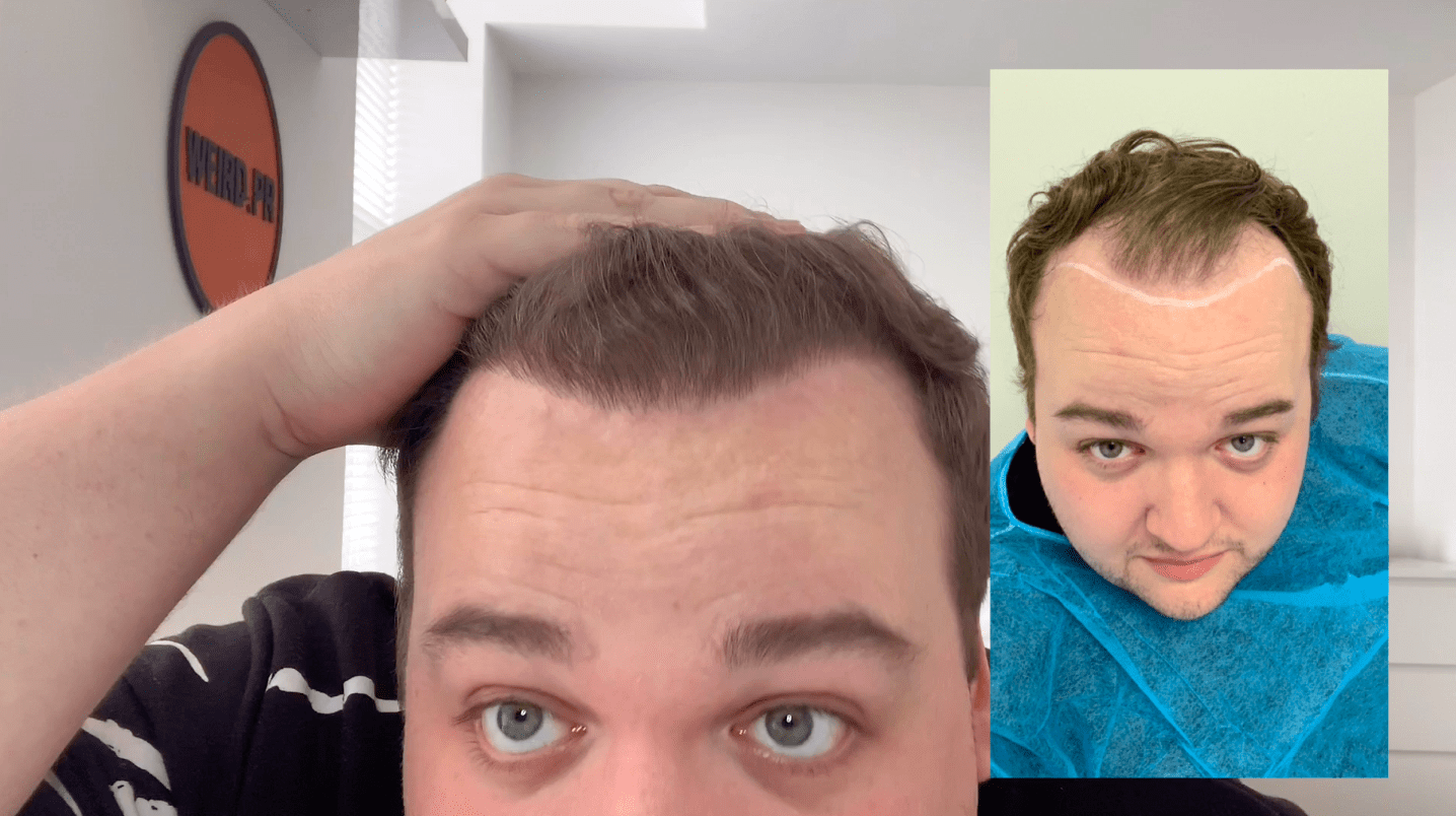 KSL hair transplant