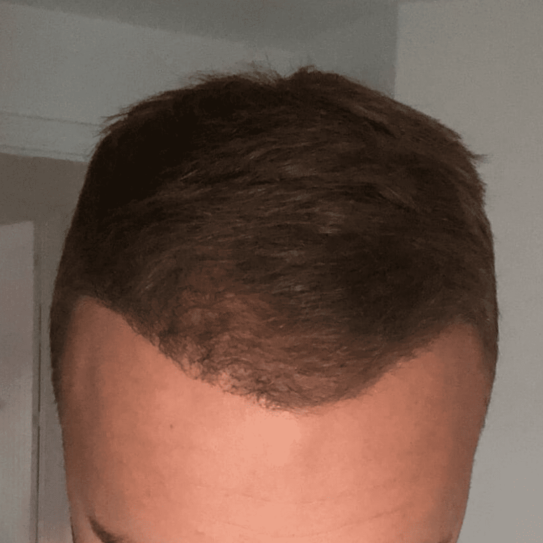 KSL hair transplant
