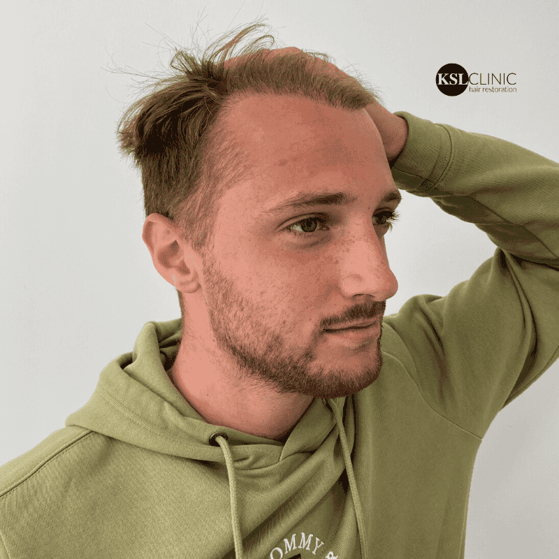 KSL hair transplant