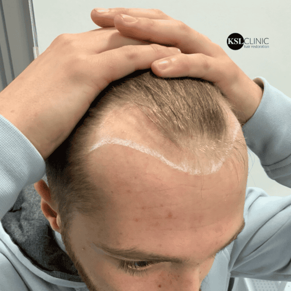 KSL hair transplant
