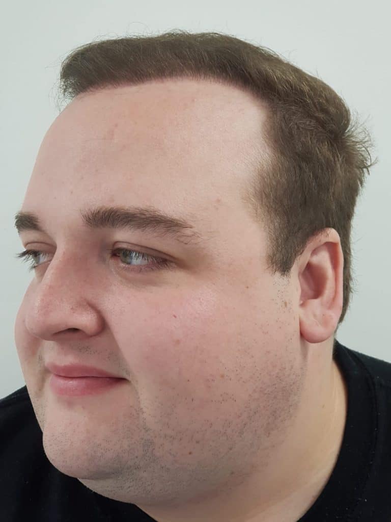 KSL hair transplant