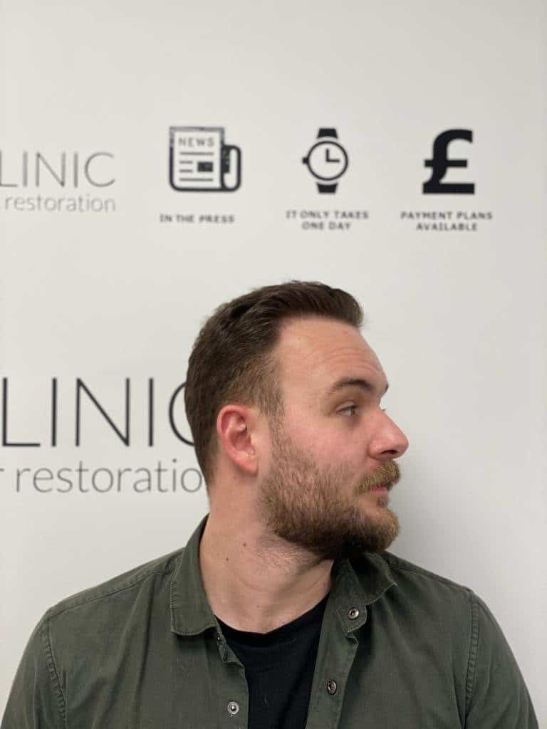 KSL hair transplant