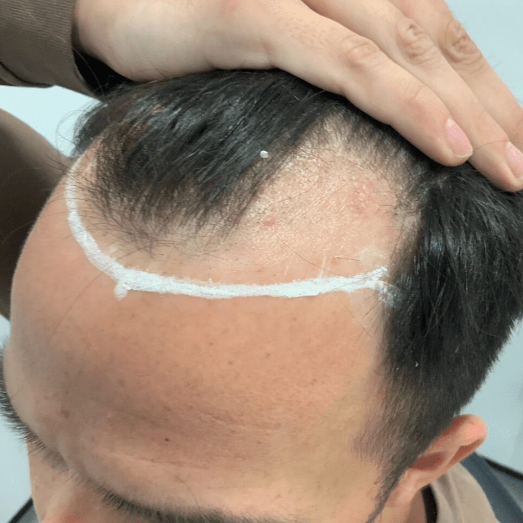 KSL hair transplant