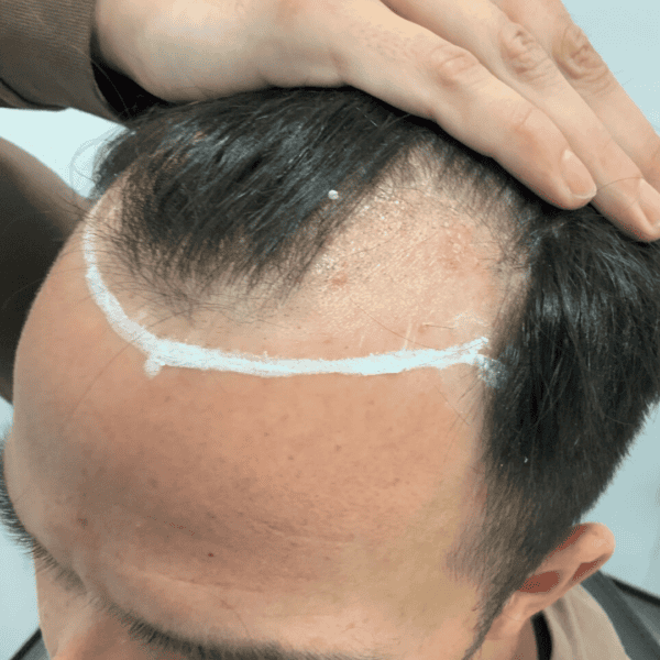 KSL hair transplant