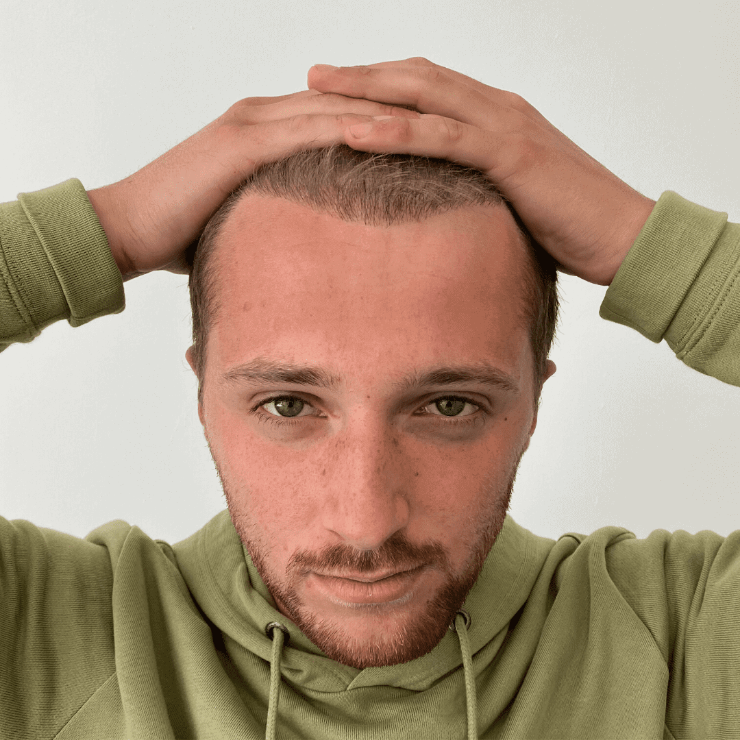 KSL hair transplant
