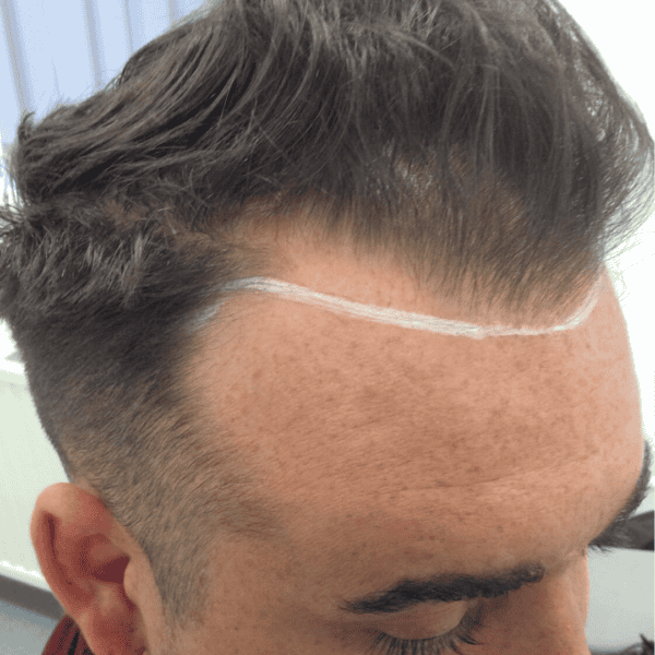 KSL hair transplant