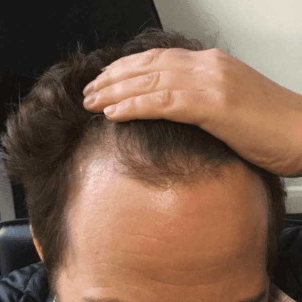 KSL hair transplant