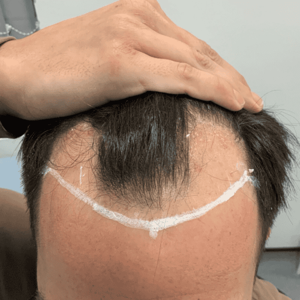 KSL hair transplant