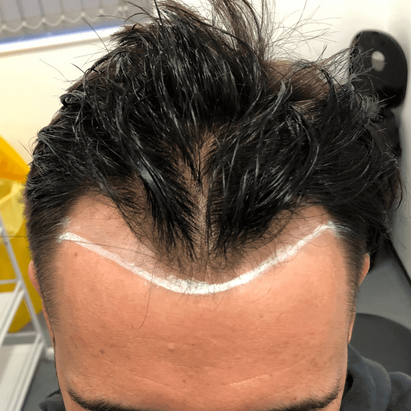 KSL hair transplant
