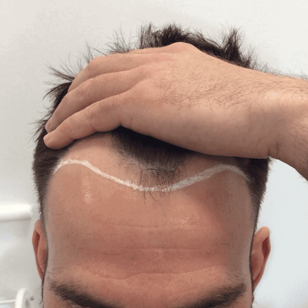 KSL hair transplant