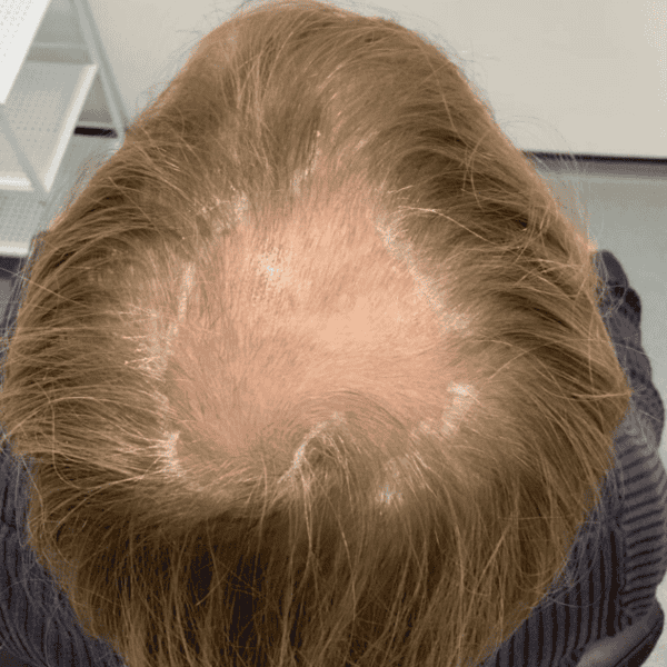 KSL hair transplant