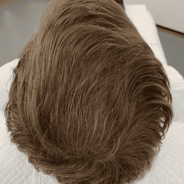 KSL hair transplant