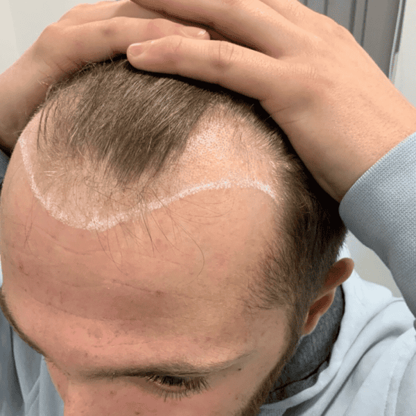 KSL hair transplant