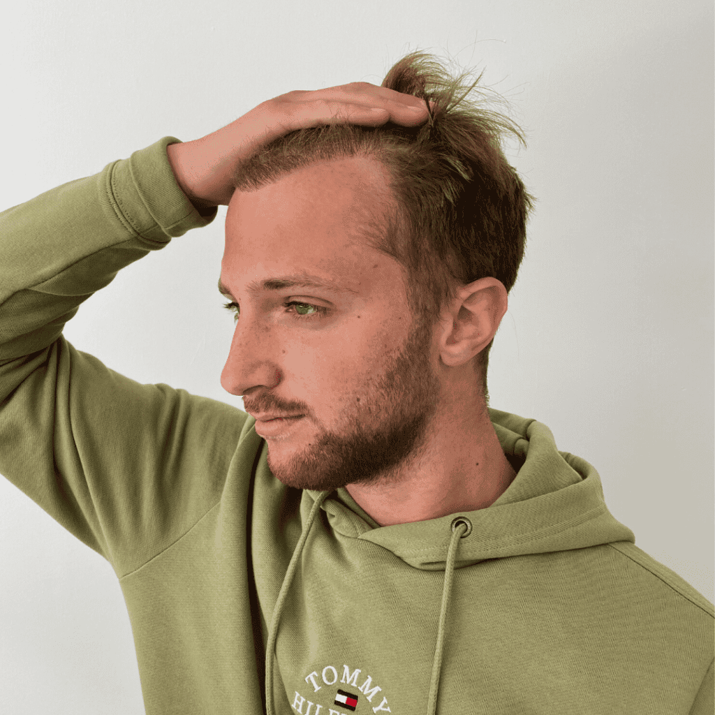 KSL hair transplant