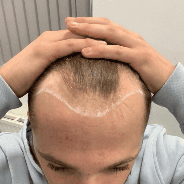 KSL hair transplant