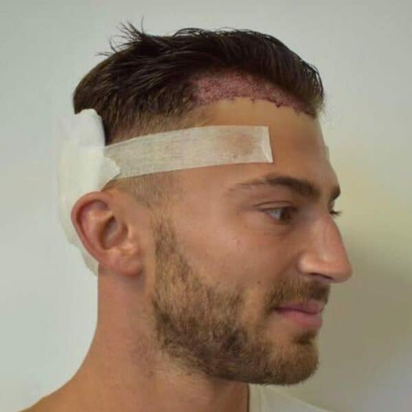 KSL hair transplant