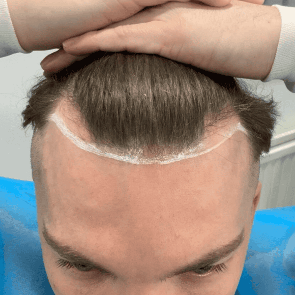 KSL hair transplant