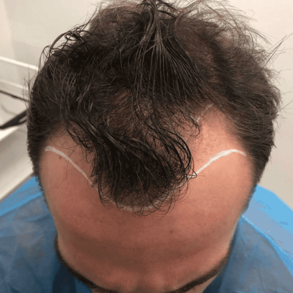 KSL hair transplant
