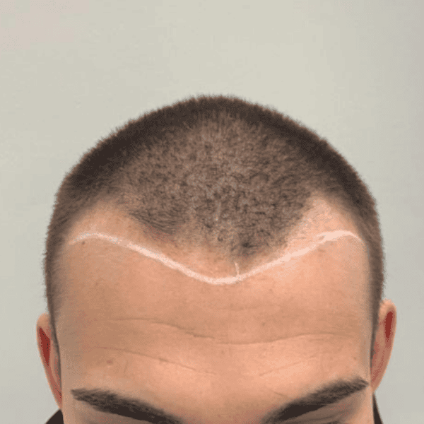 KSL hair transplant