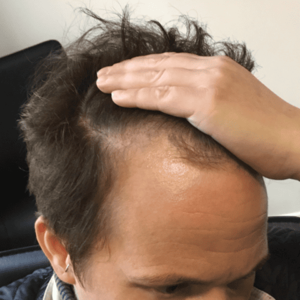 KSL hair transplant