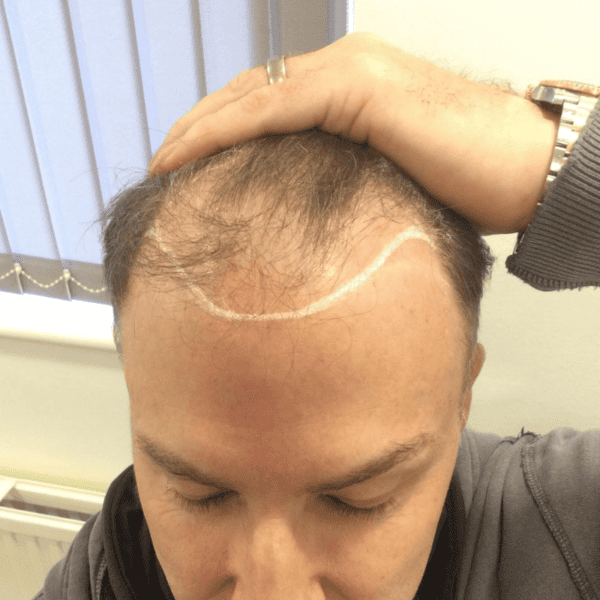 KSL hair transplant