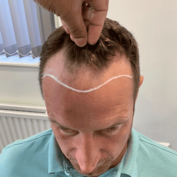 KSL hair transplant