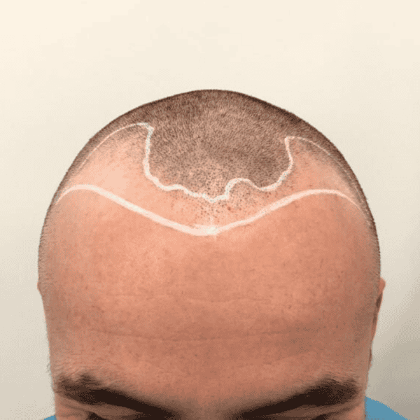 KSL hair transplant