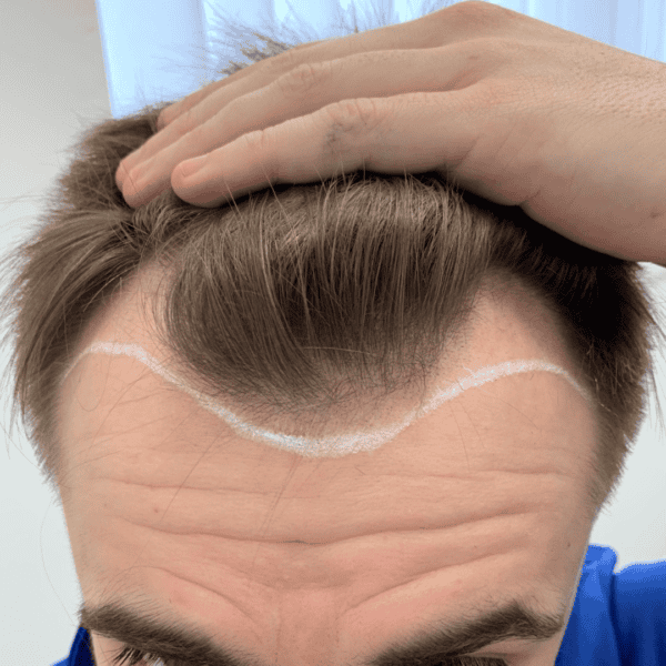 KSL hair transplant