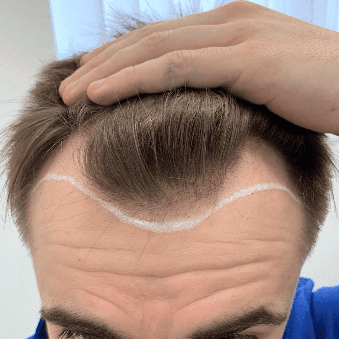 KSL hair transplant